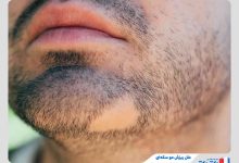 Alopecia areata causes 3 220x150 - آشنایی با عمل تیپ پلاستی بینی و کاربردهای آن