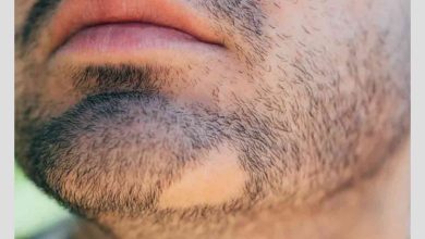 Alopecia areata causes 3 390x220 - ریزش مو سکه ای؛ 5 علت ریزش سکه ای مو و درمان فوری آنها