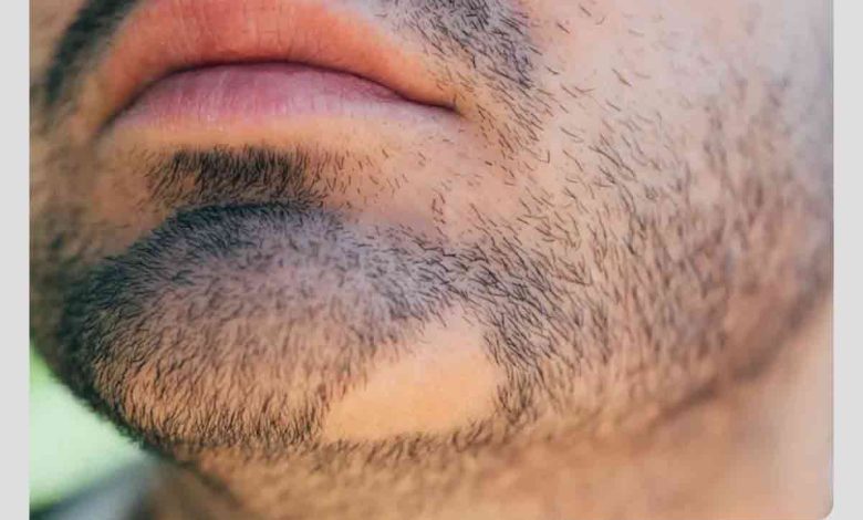 ریزش مو سکه ای؛ 5 علت ریزش سکه ای مو و درمان فوری آنها Alopecia areata causes 3 780x470 - ریزش مو سکه ای؛ 5 علت ریزش سکه ای مو و درمان فوری آنها