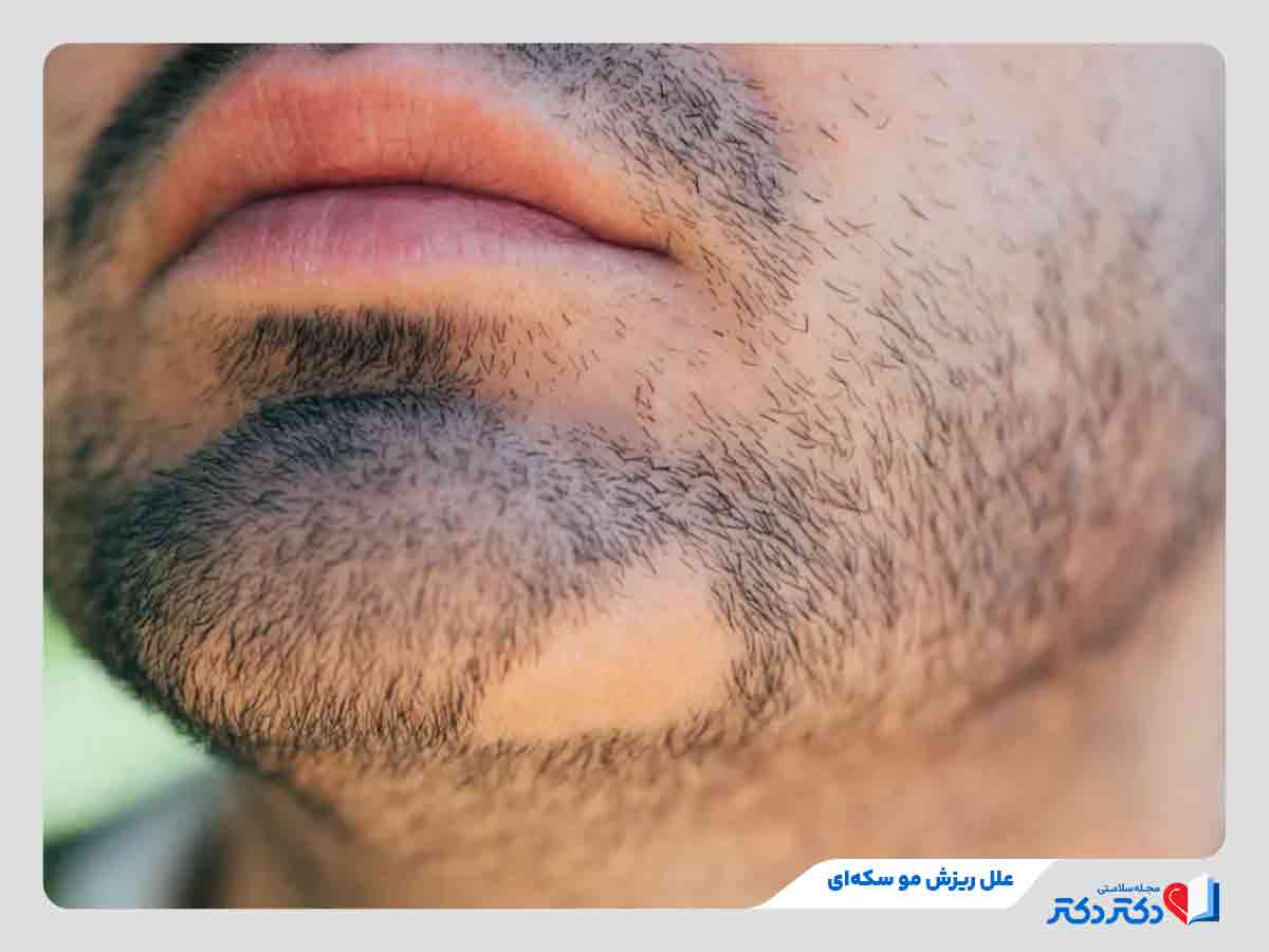 Alopecia areata causes - ریزش مو سکه ای؛ 5 علت ریزش سکه ای مو و درمان فوری آنها