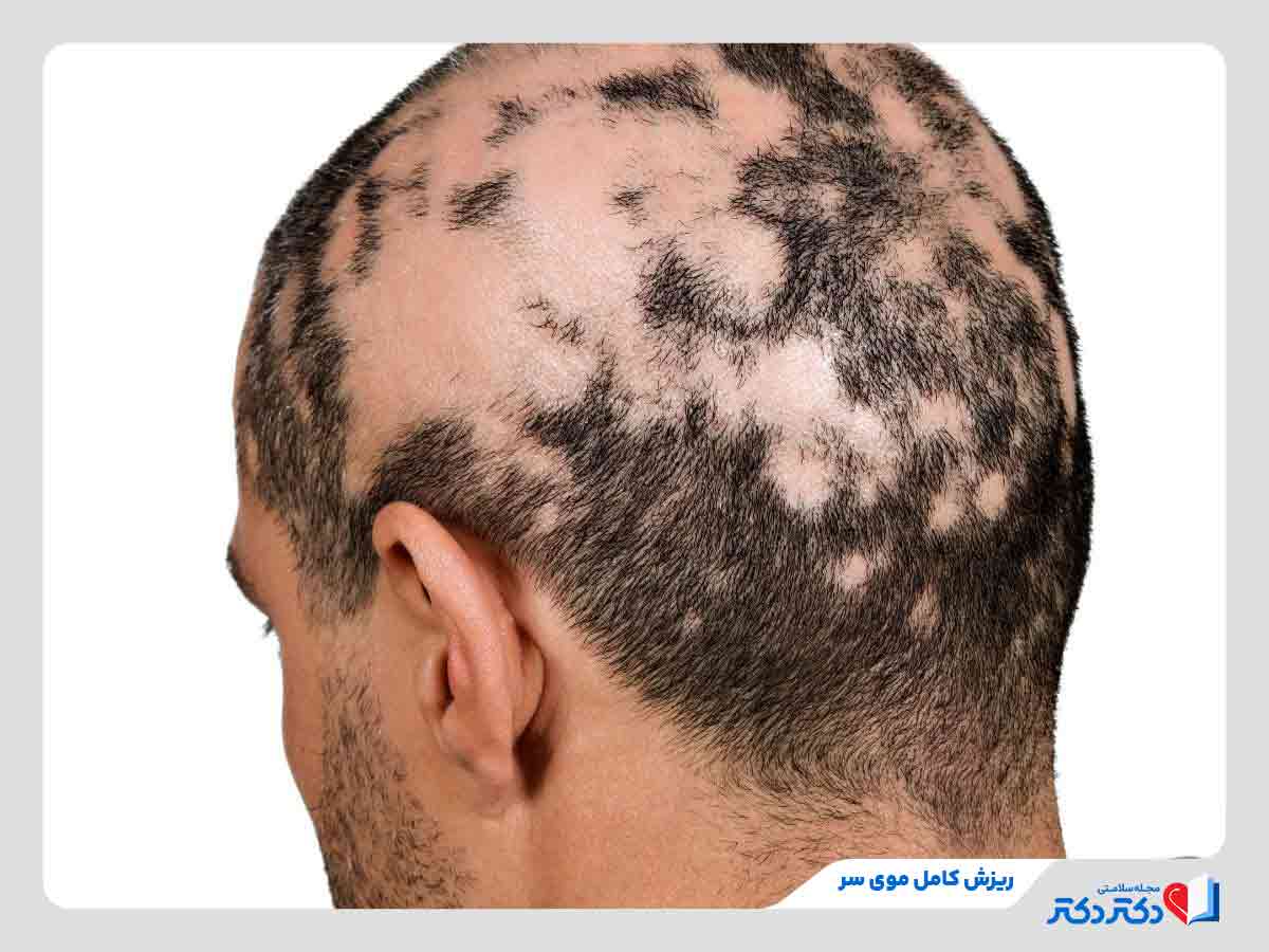 Alopecia totalis - ریزش مو سکه ای؛ 5 علت ریزش سکه ای مو و درمان فوری آنها