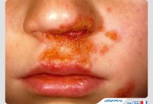 Nonbullous Impetigo 220x150 - علائم عود سرطان روده بزرگ چیست؟