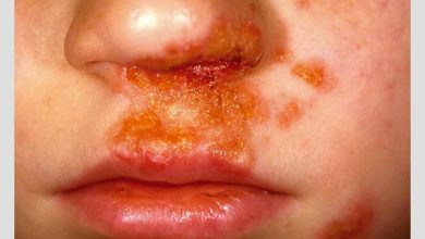 Nonbullous Impetigo 390x220 - زرد زخم چیست و چگونه درمان می‌شود؟