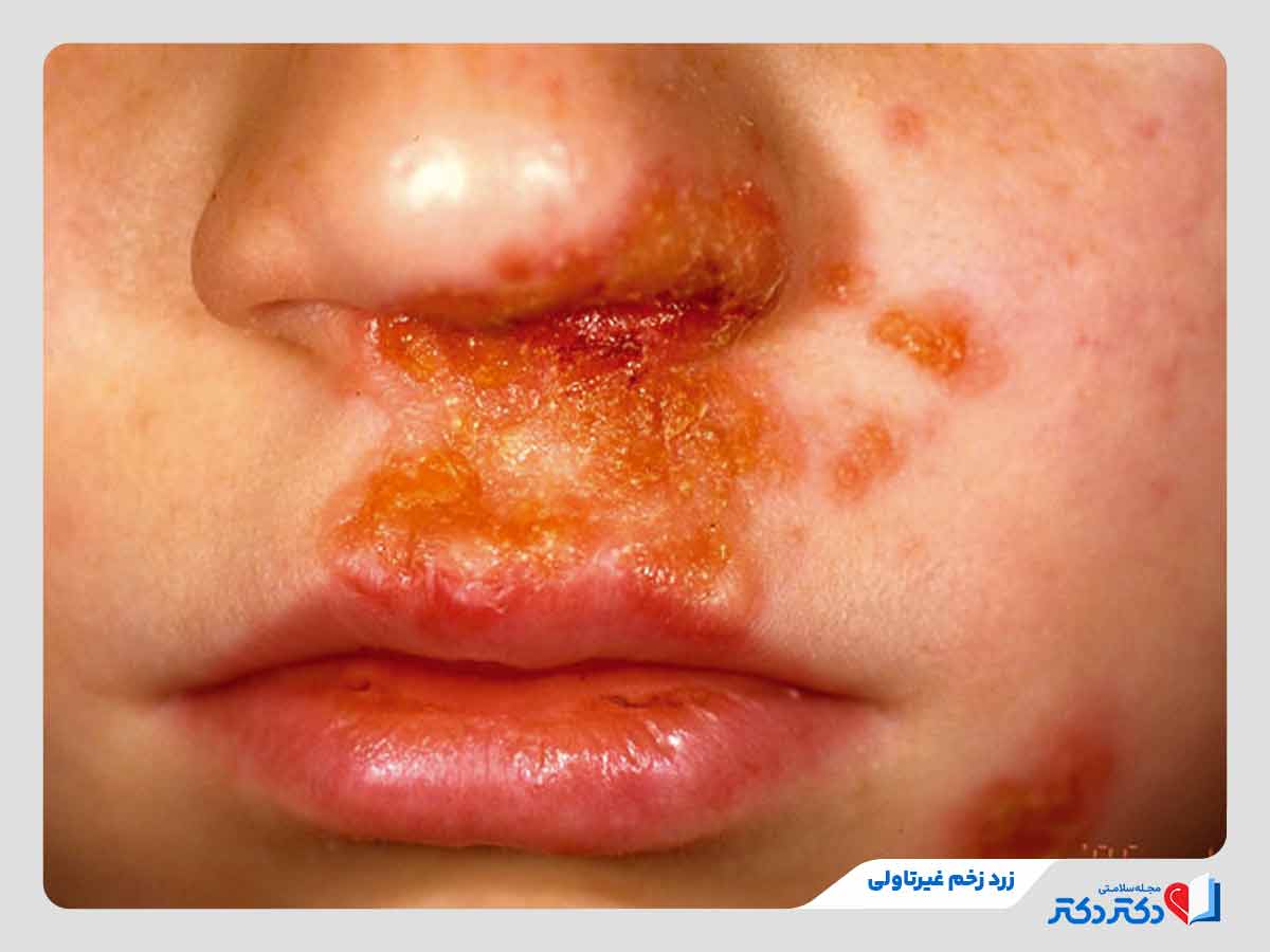 Nonbullous Impetigo - زرد زخم چیست و چگونه درمان می&zwnj;شود؟