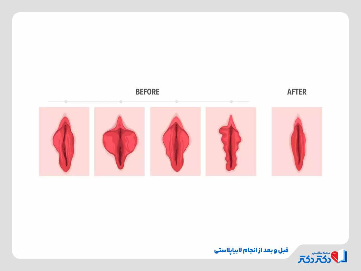 labiaplasty 1 - لابیاپلاستی چیست؟ + نکات مهم قبل و بعد از عمل