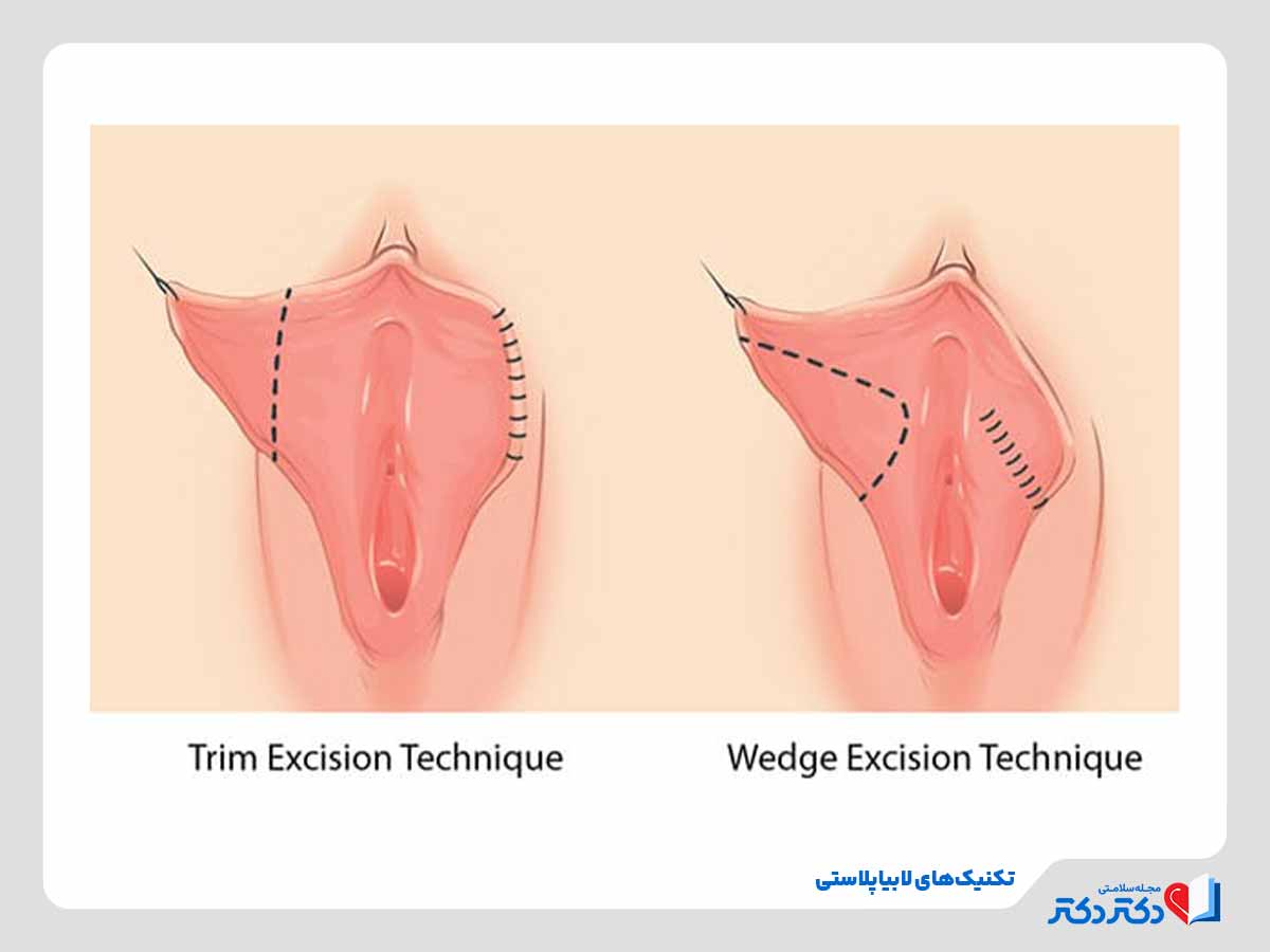 technique labiaplasty - لابیاپلاستی چیست؟ + نکات مهم قبل و بعد از عمل