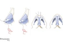 چقدر با علائم سرطان مغز استخوان آشنا هستید؟ nose surgery tip plasty photo 220x150 - چقدر با علائم سرطان مغز استخوان آشنا هستید؟