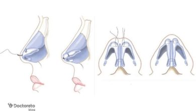 آشنایی با عمل تیپ پلاستی بینی و کاربردهای آن nose surgery tip plasty photo 390x220 - آشنایی با عمل تیپ پلاستی بینی و کاربردهای آن