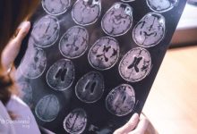 Alzheimers life expectancy 2 220x150 - بررسی تمامی علائم ضربه مغزی