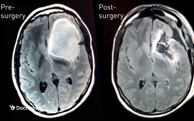 عکس تومور مغزی بدخیم malignant brain tumor image 5 1 - عکس تومور مغزی بدخیم