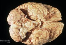 malignant brain tumor image10 220x150 - پرمصرف&zwnj;ترین کشورهای جهان بر اساس سرانه مصرف انرژی در سال ۲۰۲۴ + اینفوگرافی