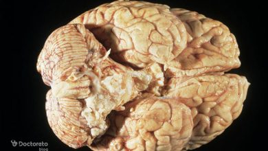 malignant brain tumor image10 390x220 - عکس تومور مغزی بدخیم