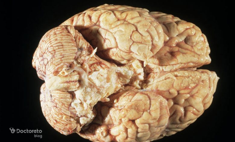عکس تومور مغزی بدخیم malignant brain tumor image10 780x470 - عکس تومور مغزی بدخیم