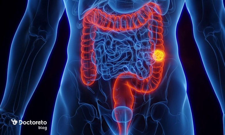 عاقبت سرطان روده چیست؟ Bowel cancer 4 min 780x470 - عاقبت سرطان روده چیست؟