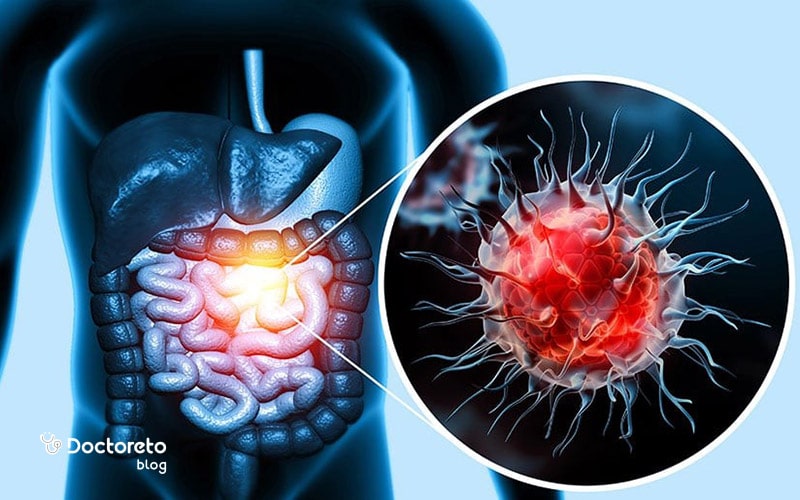 عاقبت سرطان روده چیست؟ Bowel cancer 5 2 min - عاقبت سرطان روده چیست؟