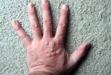 سرگیجه و چربی خون چه ارتباطی با هم دارند؟ Diabetic blisters 220x150 - سرگیجه و چربی خون چه ارتباطی با هم دارند؟