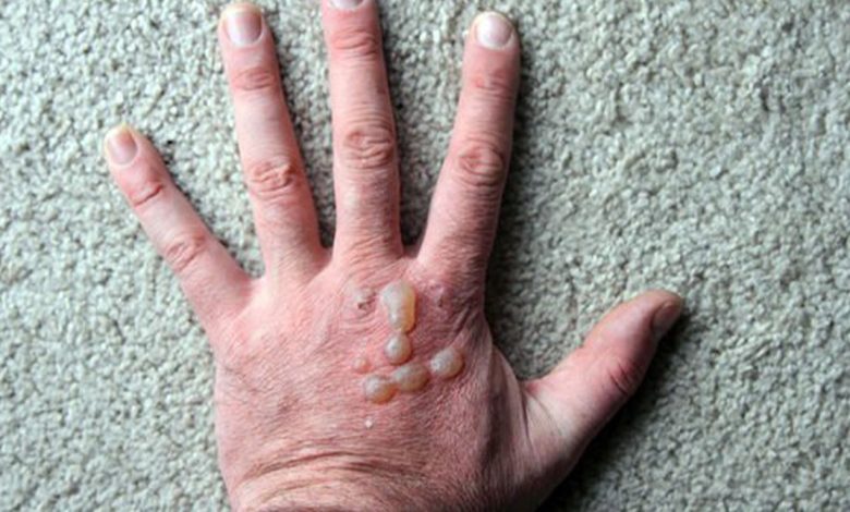 Diabetic blisters 780x470 - تب برفکی در انسان کشنده است؟ این بیماری چه علائمی دارد؟