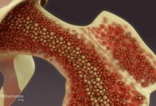 bone marrow cancer 3 220x150 - مقایسه جنگنده&zwnj;های اف-۱۴ تامکت و یوروفایتر تایفون؛ کدام شکارچی بهتر است؟