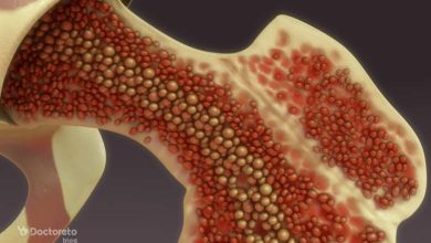 bone marrow cancer 3 390x220 - چقدر با علائم سرطان مغز استخوان آشنا هستید؟