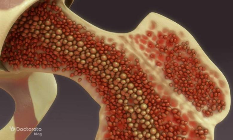 bone marrow cancer 3 780x470 - چقدر با علائم سرطان مغز استخوان آشنا هستید؟