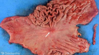 efduh1 390x220 - چقدر با سرطان معده بدخیم آشنا هستید؟