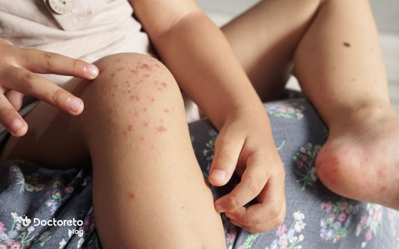 hand foot and mouth disease 1 - تب برفکی در انسان کشنده است؟ این بیماری چه علائمی دارد؟