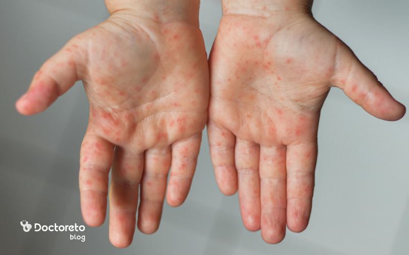 hand foot and mouth disease - تب برفکی در انسان کشنده است؟ این بیماری چه علائمی دارد؟