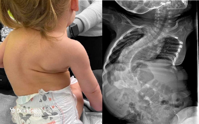 sma 2 - هر آنچه که باید در مورد بیماری اس ام ای بدانید