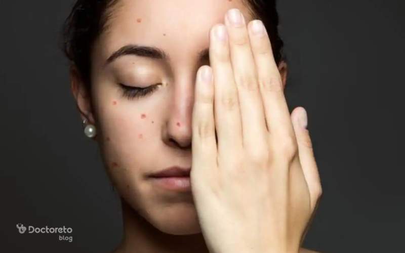 When does chickenpox leave scars 1 - در چه صورت جای آبله مرغان می ماند؟