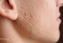 When does chickenpox leave scars 2 220x150 - بازسازی ساختمان و مدیریت ریسک