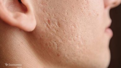 When does chickenpox leave scars 2 390x220 - در چه صورت جای آبله مرغان می ماند؟