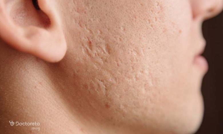 When does chickenpox leave scars 2 780x470 - در چه صورت جای آبله مرغان می ماند؟