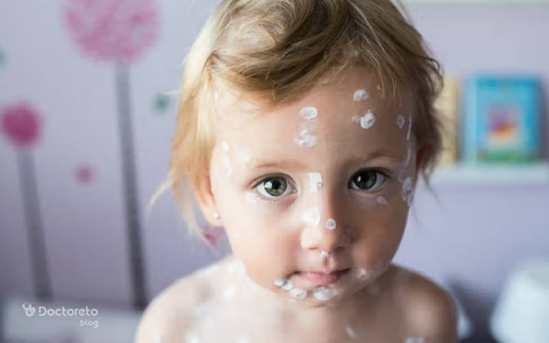 chickenpox 1 - در چه صورت جای آبله مرغان می ماند؟