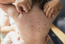 chickenpox anti itch tablet 220x150 - بررسی تمامی علائم ضربه مغزی