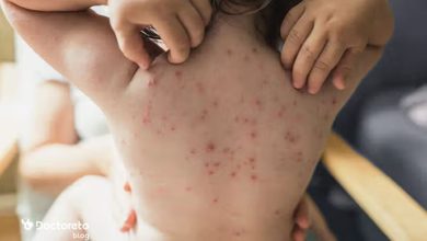 chickenpox anti itch tablet 390x220 - کدام قرص ضد خارش ابله مرغان تاثیر بیشتری دارد؟