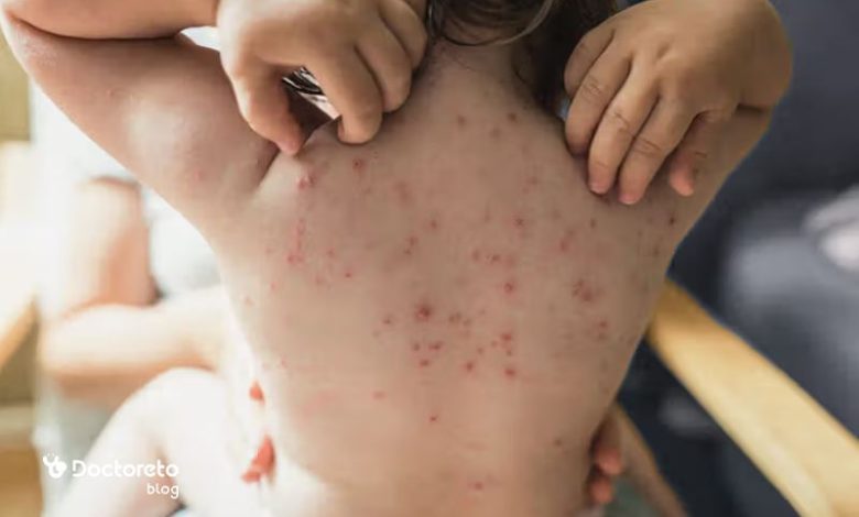 chickenpox anti itch tablet 780x470 - کدام قرص ضد خارش ابله مرغان تاثیر بیشتری دارد؟