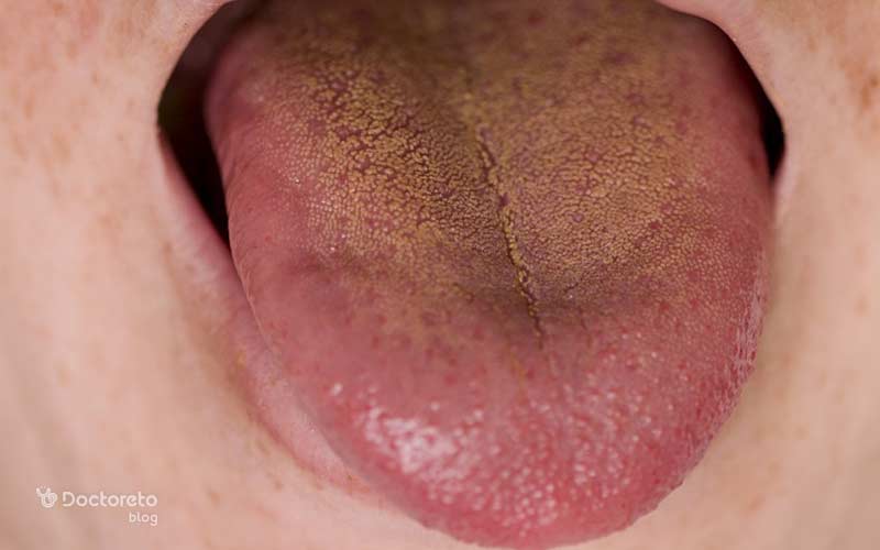 fatty liver symptoms on the tongue1 - کبد و تلخی دهان؛ چرا مشکلات کبدی طعم دهان را تلخ می&zwnj; کند؟