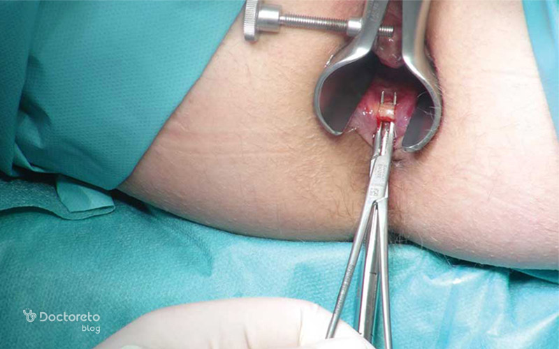 درمان شقاق مقعدی؛ از درمان خانگی تا روش های جدید پزشکی anal fissure treatment 2 - درمان شقاق مقعدی؛ از درمان خانگی تا روش های جدید پزشکی