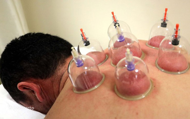 benefits cupping 2 - فواید حجامت چیست؟ بررسی خواص احتمالی با شواهد علمی