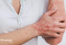 dermatitis 220x150 - بررسی تمامی علل حساسیت پوستی خارش و قرمزی