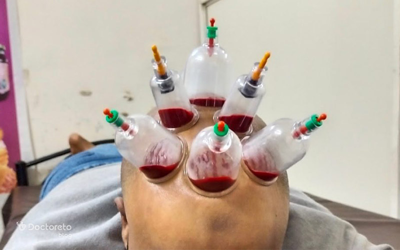 head cupping 1 - حجامت سر چگونه است؟ چه فواید و عوارضی دارد؟