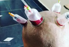 head cupping 3 220x150 - حجامت سر چگونه است؟ چه فواید و عوارضی دارد؟