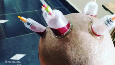 head cupping 3 390x220 - حجامت سر چگونه است؟ چه فواید و عوارضی دارد؟