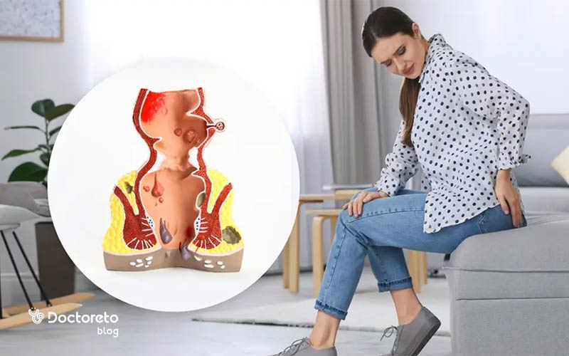 علت بواسیر در زنان چیست و چگونه باید درمان شود؟ hemorrhoid 20 - علت بواسیر در زنان چیست و چگونه باید درمان شود؟