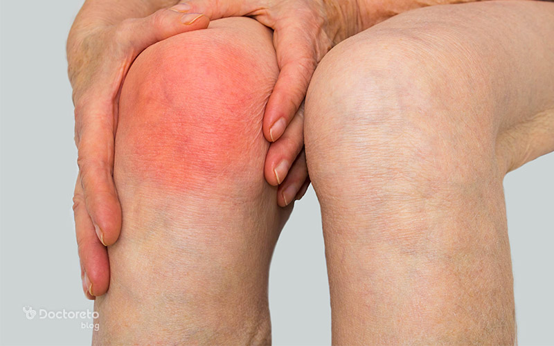 آرتریت سپتیک چیست؟ علائم، علت و راه های درمان عفونت مفصل septic arthritis 1 - آرتریت سپتیک چیست؟ علائم، علت و راه های درمان عفونت مفصل