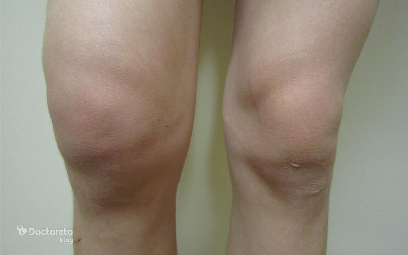 آرتریت سپتیک چیست؟ علائم، علت و راه های درمان عفونت مفصل septic arthritis 3 - آرتریت سپتیک چیست؟ علائم، علت و راه های درمان عفونت مفصل