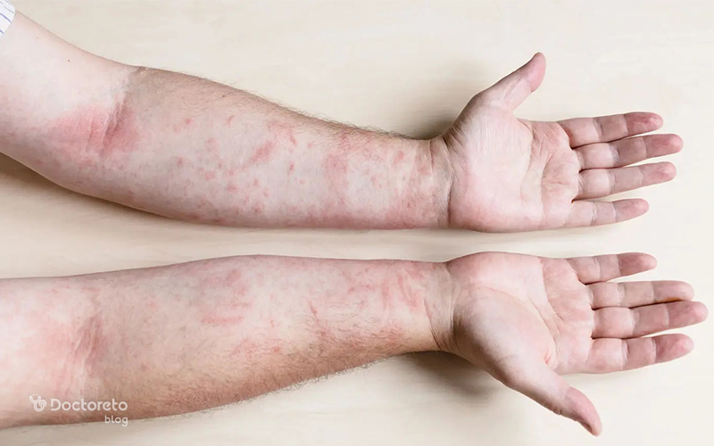 skin sensitivity itching redness 1 - بررسی تمامی علل حساسیت پوستی خارش و قرمزی