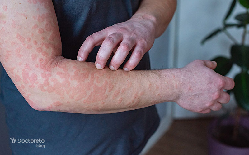 skin sensitivity itching redness 3 - بررسی تمامی علل حساسیت پوستی خارش و قرمزی
