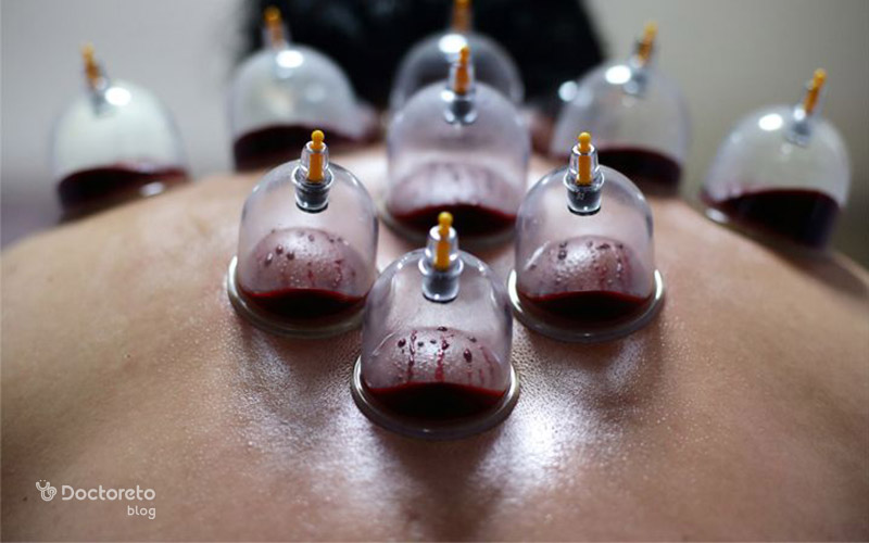 who should cupping 1 - چه کسانی باید حجامت کنند و چه کسانی باید احتیاط کنند؟