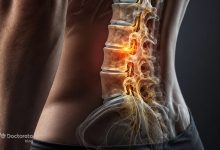 Laser treatment for spinal stenosis 2 220x150 - تنگی کانال نخاع کمر چه علائمی دارد؟ تا چه اندازه خطرناک است؟